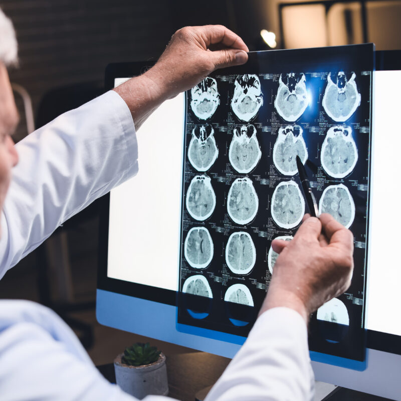 Alzheimer's brain scans