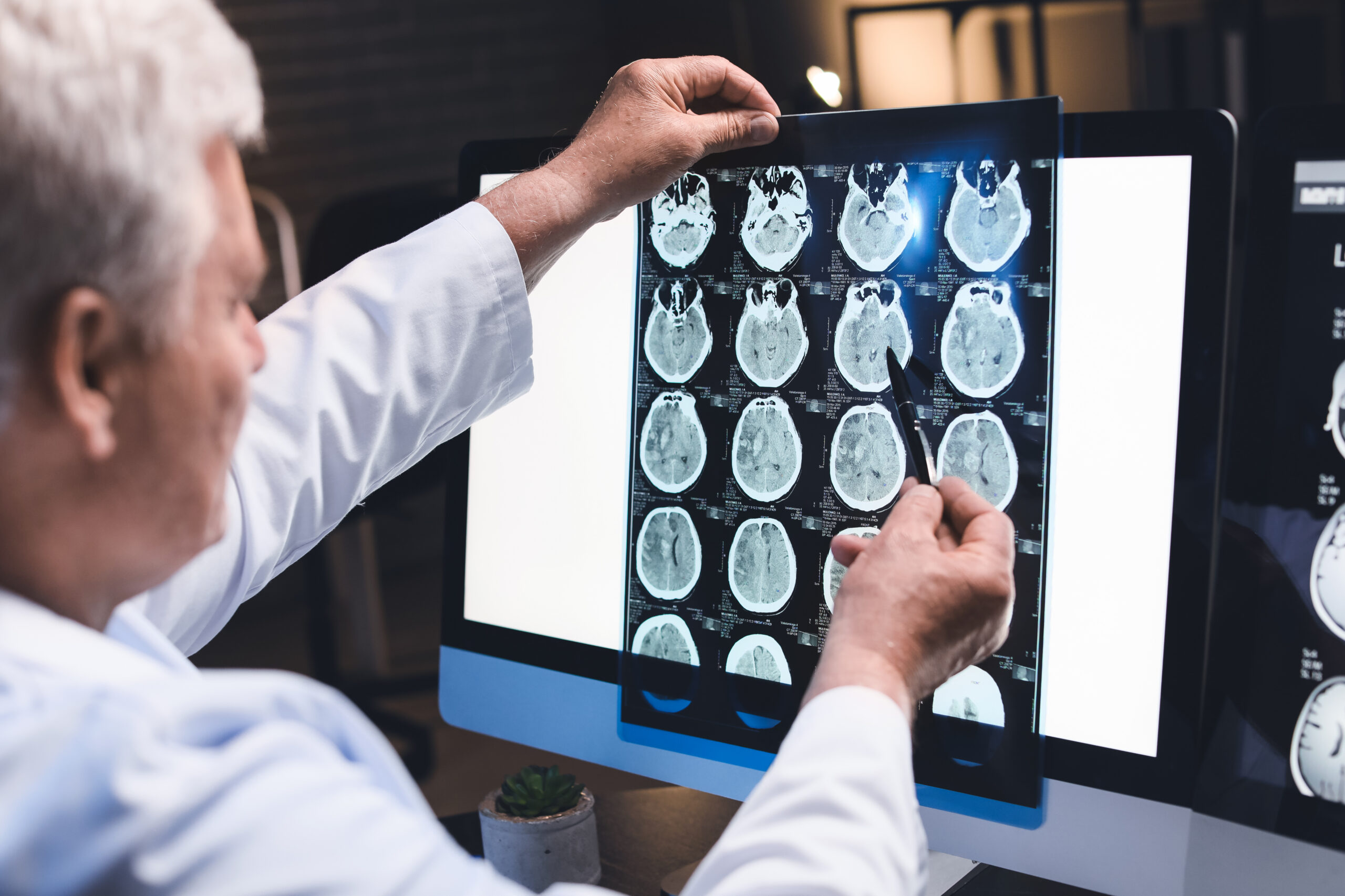 Alzheimer's brain scans